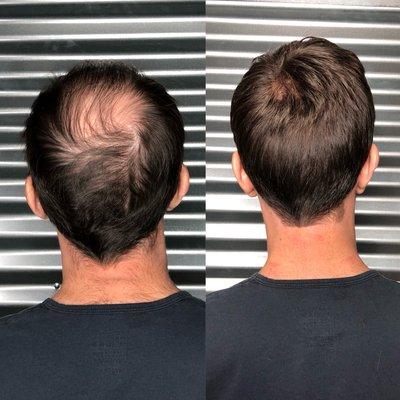 Non surgical hair replacement for men (or women) that are experiencing hair loss! Contact me for a consultation.