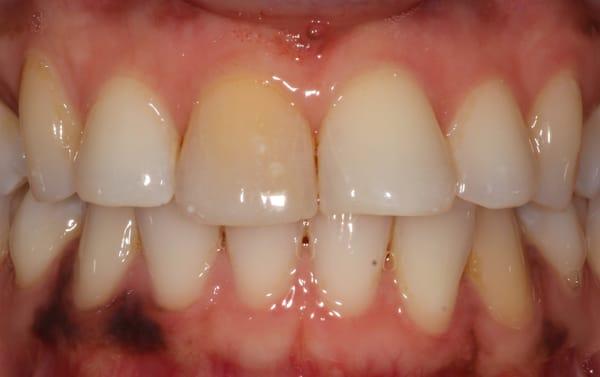 Before Photo - Improving the color of a tooth using new materials in dentistry