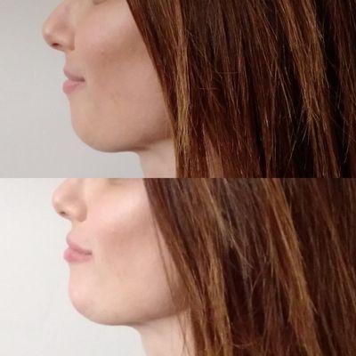 Chin augmentation with lip fillers