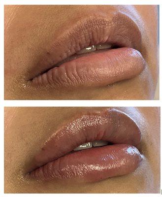 Before & After Lip Filler (half syringe)