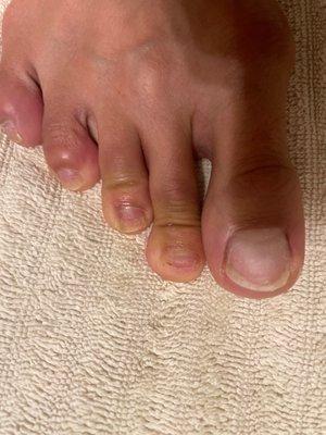 Nail fungus and missing toe nail due to rapid corrosion from a bacterial infection from Dolce Nails & Spa - Sewell, NJ.