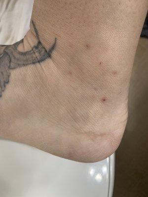 Bed bug bites