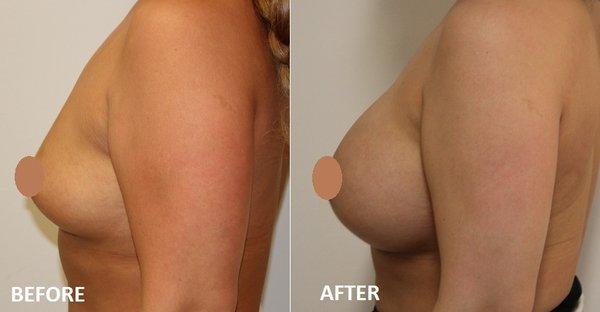 Before & After  Breast Augmentation performed by Dr.Albert Chow - 505cc hp Sientra Silicone Implants