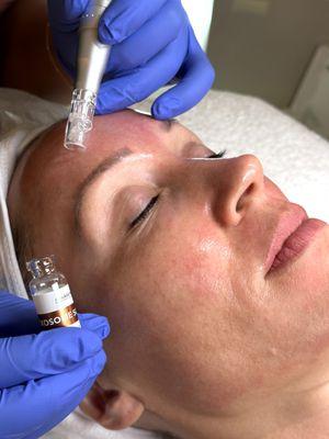 Microneedling