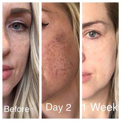 Results from an IPL treatment performed by Amy Anfuso, PA-C