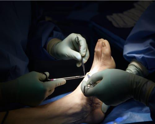 Peripheral Nerve Surgery to relieve Neuropathy