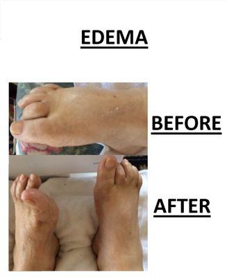 Edema before and after pictures