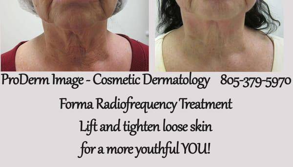 Forma - Fractional Thermal Contraction Treatment