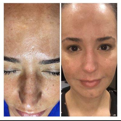 Chemical Peel 3 sessions 
Feluric
DNA 
Melaspeel
Results after 3rd treatment