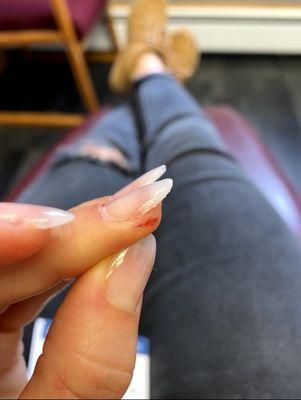 Deep cut from nail file