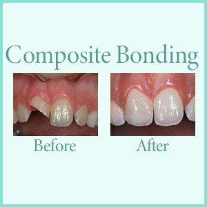 Composite Bonding preserves the tooth instead of grinding it down to a stump and adding a crown.