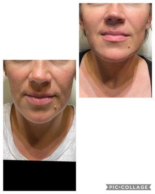 Morpheus8 face lifting! Minimally invasive with great, natural looking results.