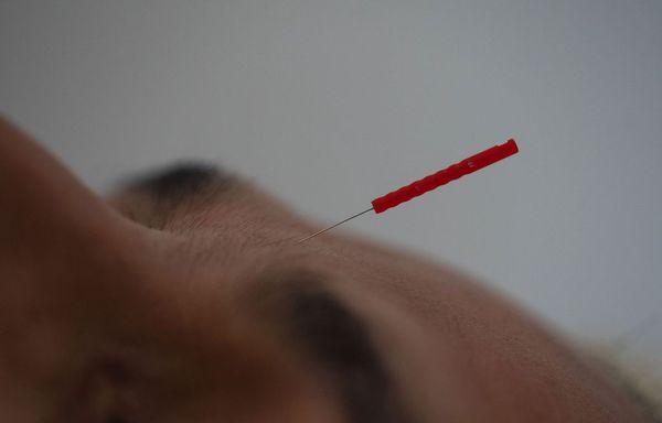 Acupuncture