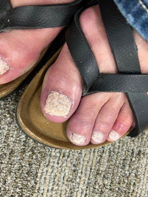 Flooded cuticles and dry skin on toes (after the "callus remover").....