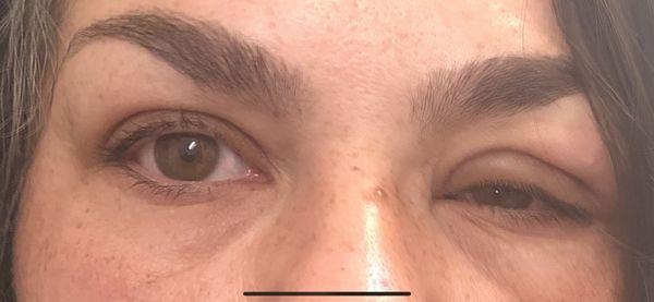 Severe Ptosis