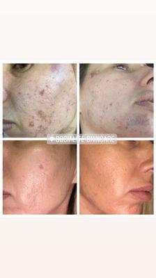 Amazing acne clearing results