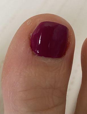 Bleeding cuticle