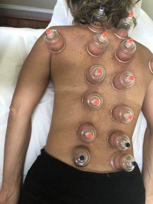 cupping Treatment for back pain