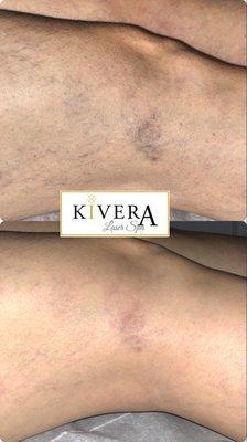 Spider Vein Removal