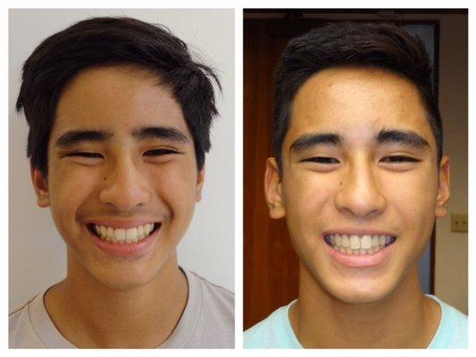 invisalign before & after