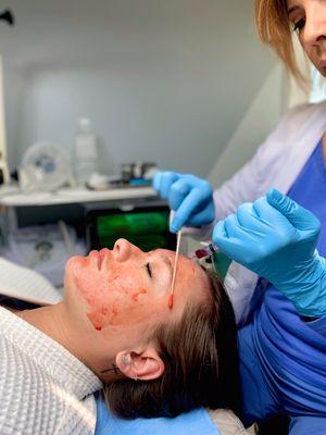 Platelet-rich plasma facial employ microneedling technique to create a more youthful skin texture.