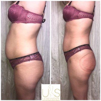 Cavitation+contour body wrap+ wood therapy+ booty plump/lift+ Ems