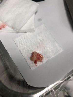 Wisdom tooth extracted