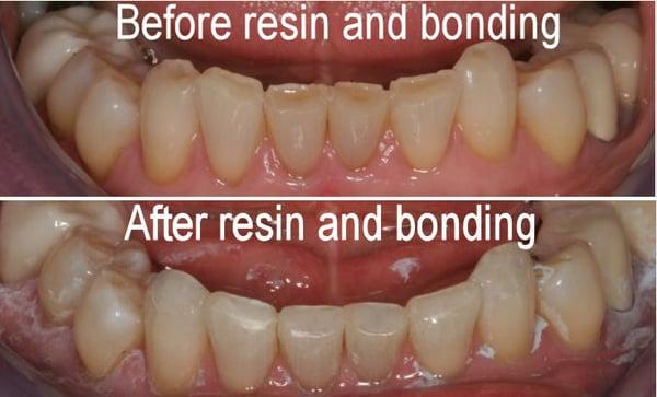 Teeth worn with age, restored and straightened with composite resin and bonding in a single sitting.