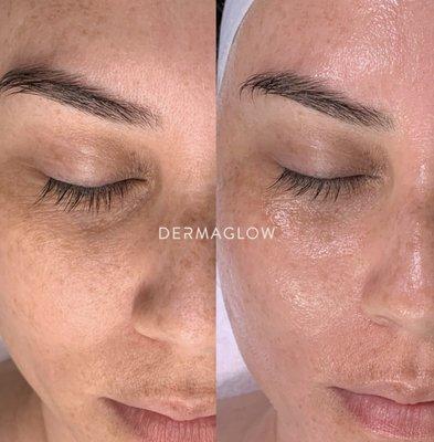 Amazing Results from a Hydrafacial