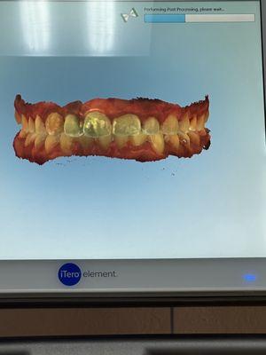 Came here for a cleaning and my night guard. They took a 3D picture of my teeth for the night guard.