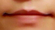 Before lip filler