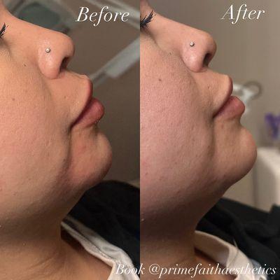 Before and after dermal fillers to the chin and jawline! Book today by texting "filler" to 469-491-9194