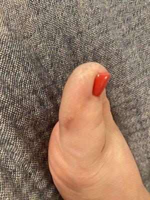 Crusty toe