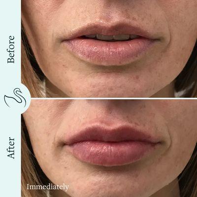 The Skin Center Before and After Lip Filler