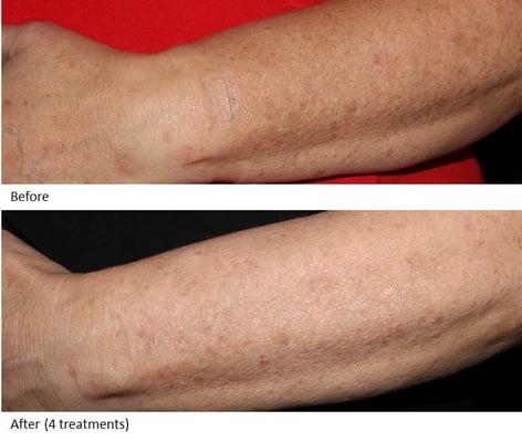 Sun Damage Laser Treatment: Before & After Photos from Dr. Rubenstein's Swedish Skin Institute (4 treatments).