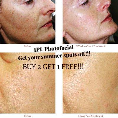 IPL - helps with Dark Spots