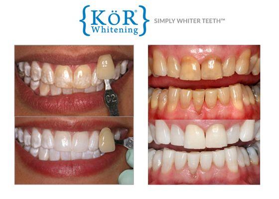 KOR Whitening is our go-to whitening gel and can even whiten severely stained and yellowed teeth.