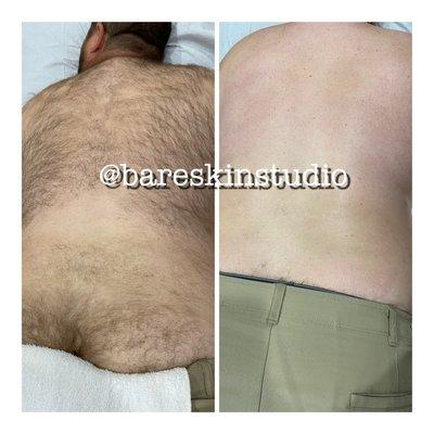 Before and after back men's back waxing.