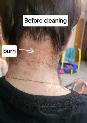 Chemical burns