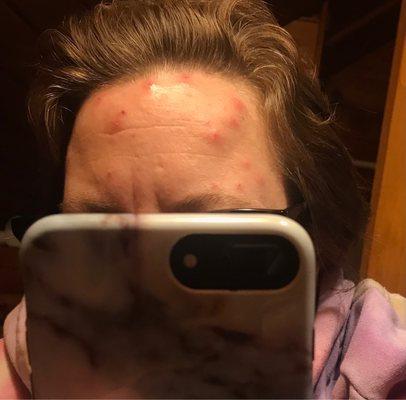 My forehead this was a second night. Bug bites