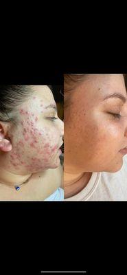 Acne client transformation