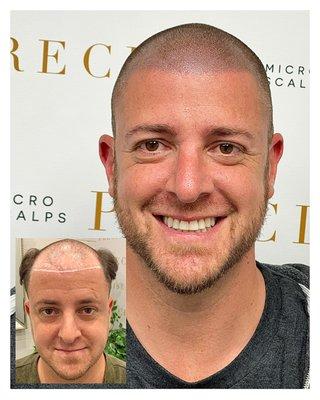 LIFE CHANGING RESULTS WITH SCALP MICROPIGMENTATION. CALL NOW FOR YOUR FREE CONSULTATION 844-4SCALPS