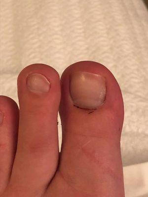 my big toe after a deluxe pedicure, sans the clear coat of polish i wanted to get. a week later and it's still reopening and bleeding