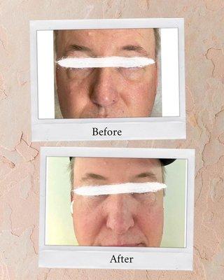 Platelet rich plasma injections for under eye hollows and dark circles