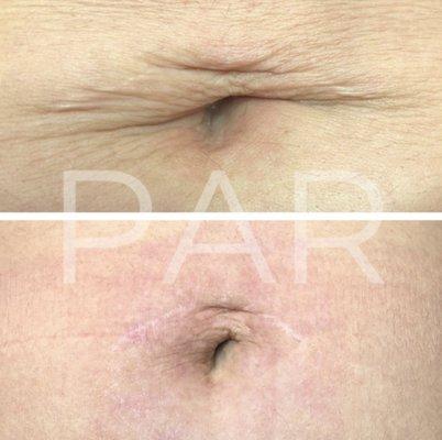 Plasma Skin tightening