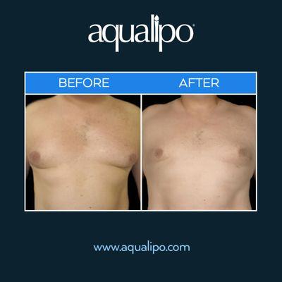 Male breast liposuction in Orlando provides a minimally-invasive solution to remove unwanted fat and sculpt the chest.