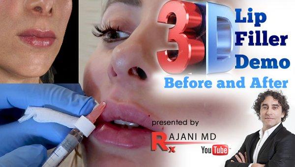 https://www.youtube.com/watch?v=Jr7RrWAPCto
 
 Dr Rajani injects lip filler in real time and explains the procedure. Watch the lips plump an