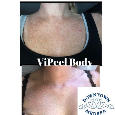 ViPeel Body