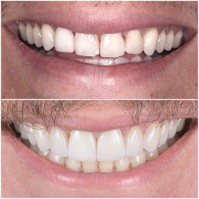 Natural porcelain veneers