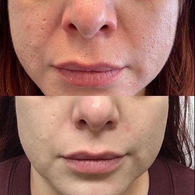 Micro needling before and after